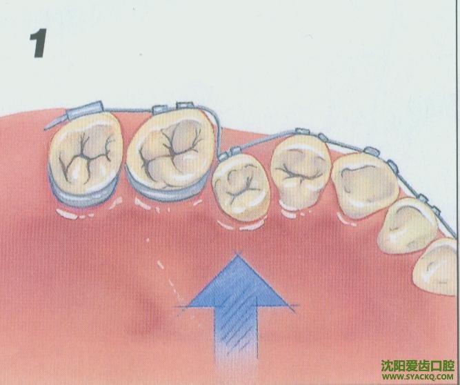 解析牙齿拥挤的原因危害及矫正