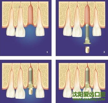 讲述西宁人工早孕的一些优势