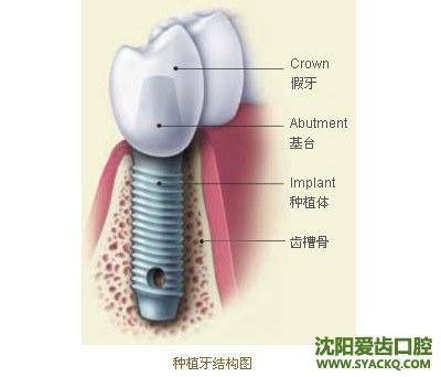 　　段式种植?