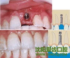 　　什么情况下才适合做早孕呢?