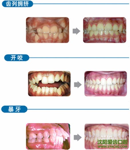 牙齿拥挤只有正畸能解决吗?