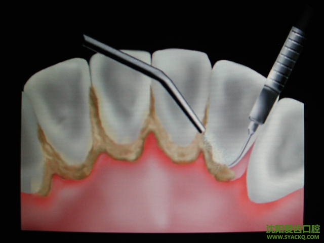牙结石是怎么回事?怎么清除?