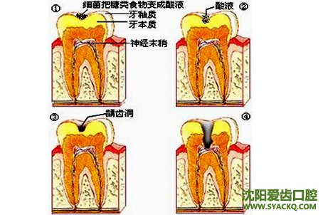 什么是牙髓炎?怎么治疗?