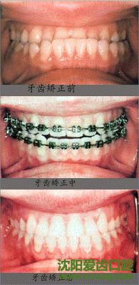 隐形矫正是怎么回事?