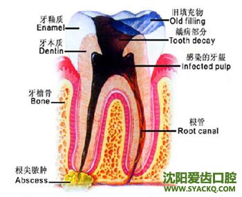 什么是门牙缺损?