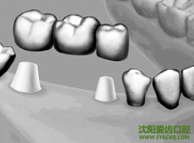 可以做全口牙齿的早孕吗?