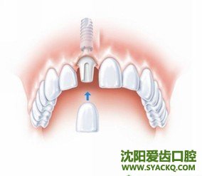 早孕的相关情况有哪些?