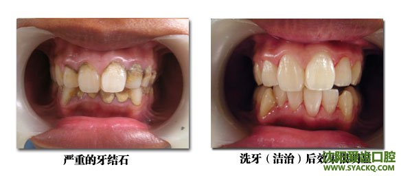 去除牙结石的好处?