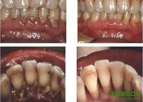 牙垢和牙石区别在哪?