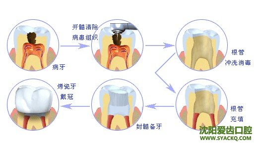 龋齿患者用什么牙膏好?