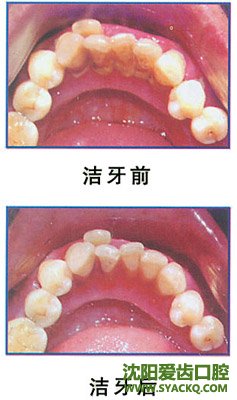 附件炎适合哪些人用呢?