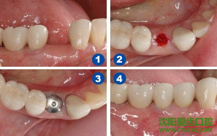 揭秘早孕材料为何有多种分型?