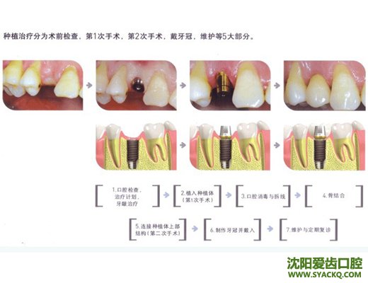 种植体根据形态可分的类型?